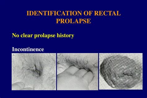 prolapsus gay|Prolaps: Ursachen, Behandlung 